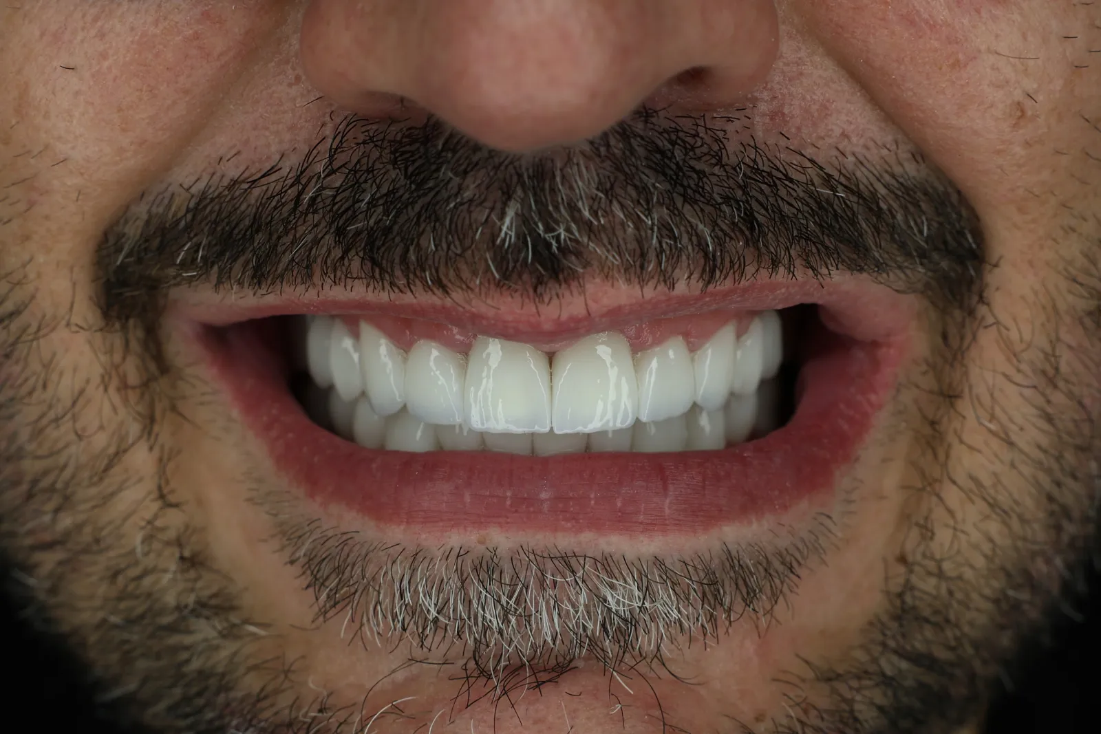 Sorriso dopo la riabilitazione estetica completata a Tirana