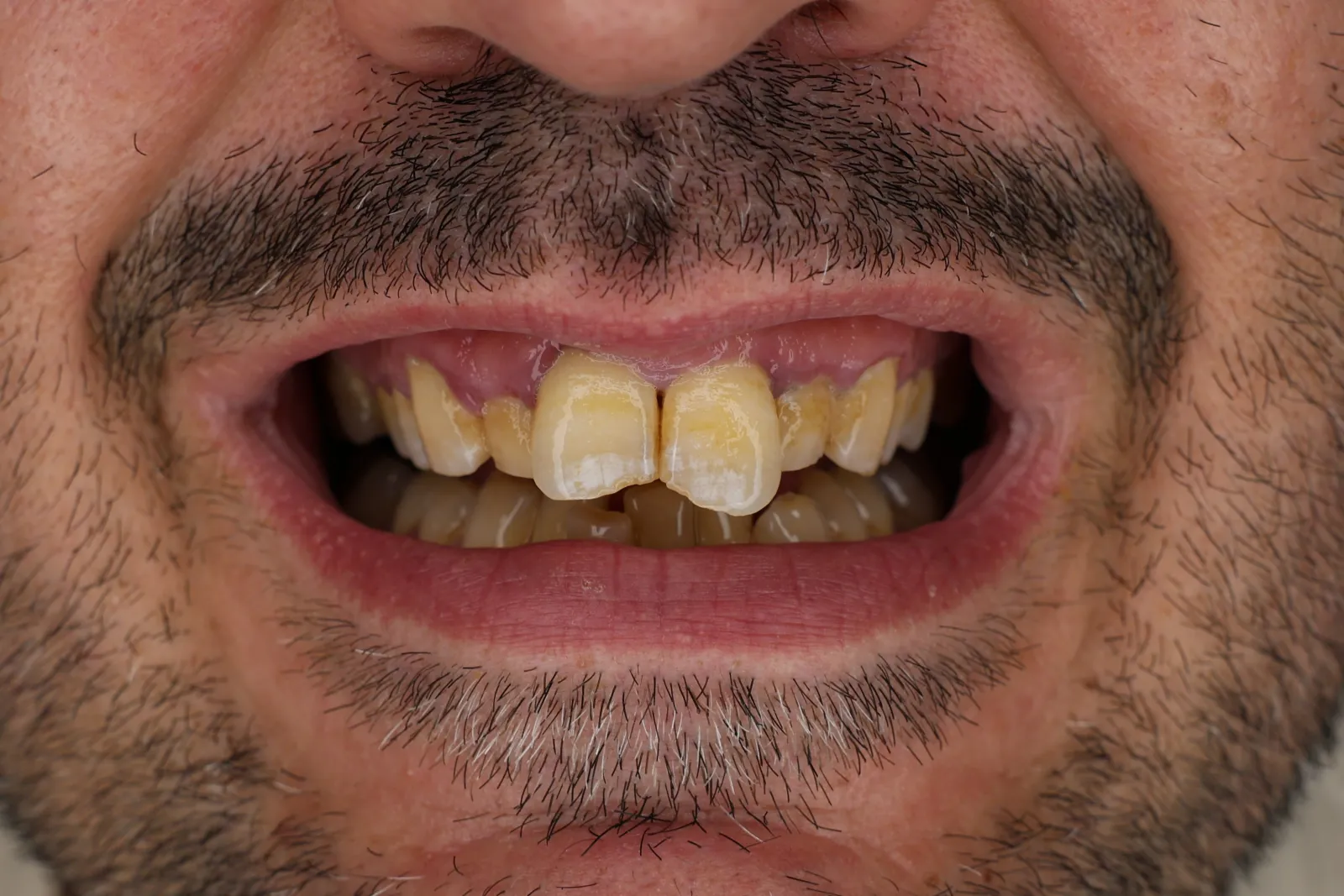Sorriso prima della riabilitazione: incisivo scheggiato e denti usurati
