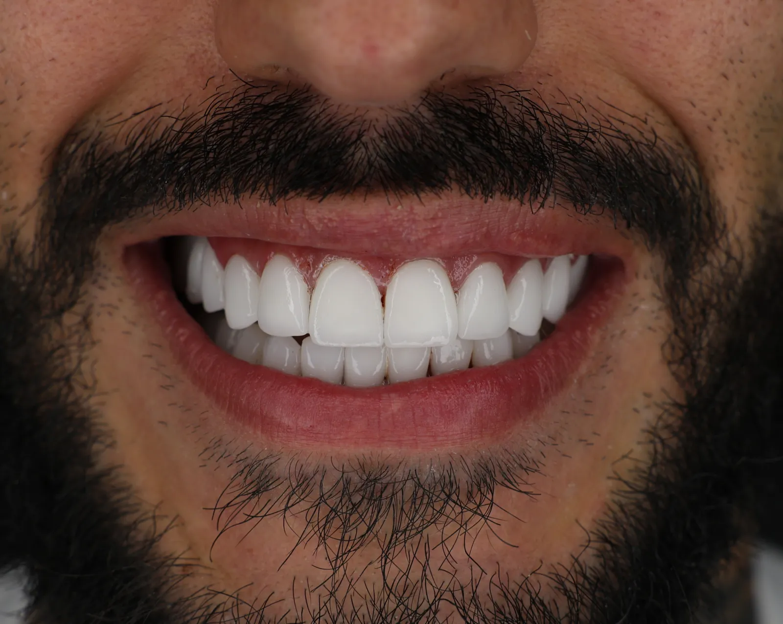 Lo stesso paziente dopo le faccette dentali in ceramica applicate a Tirana