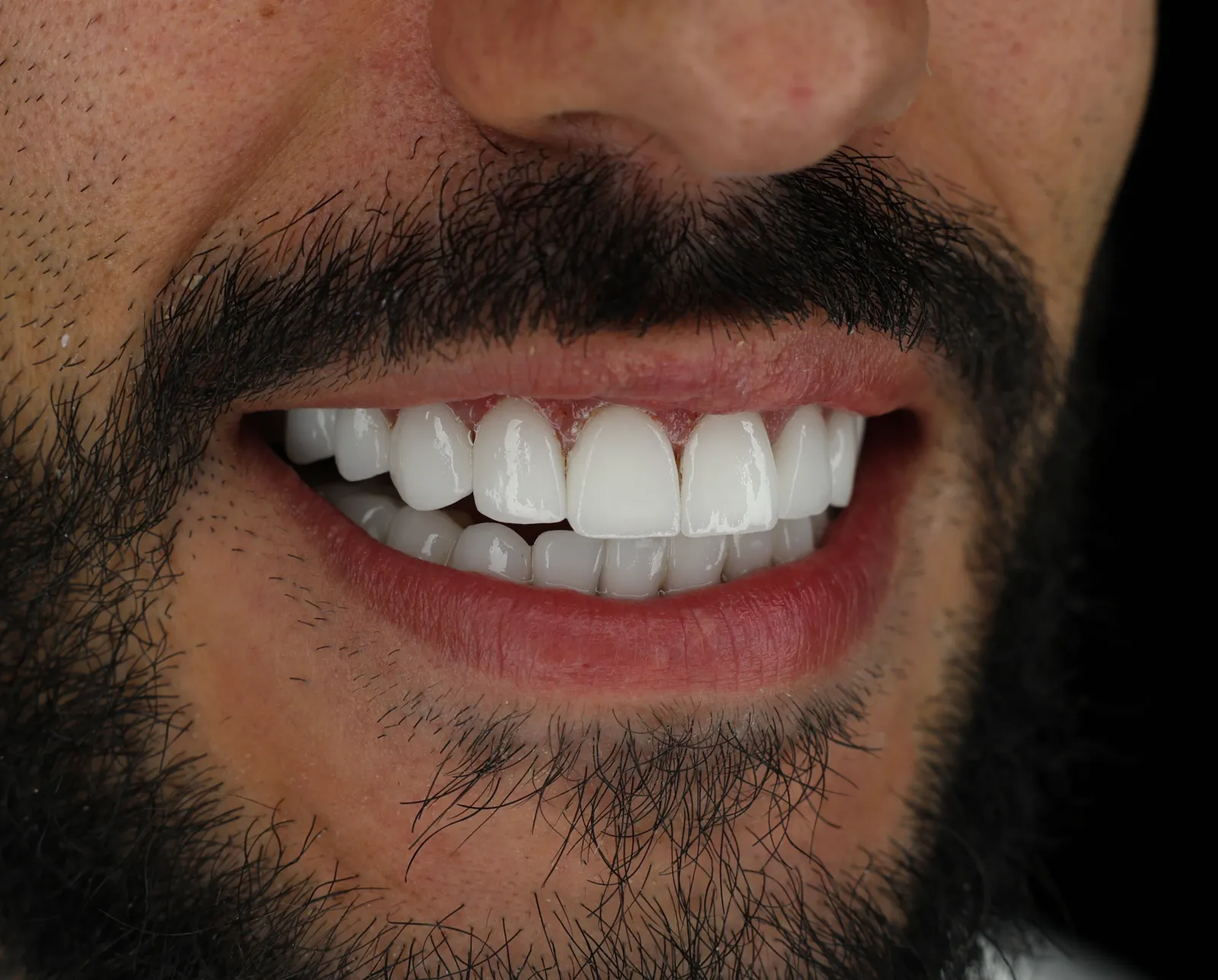 Dettaglio del sorriso dopo le faccette in ceramica