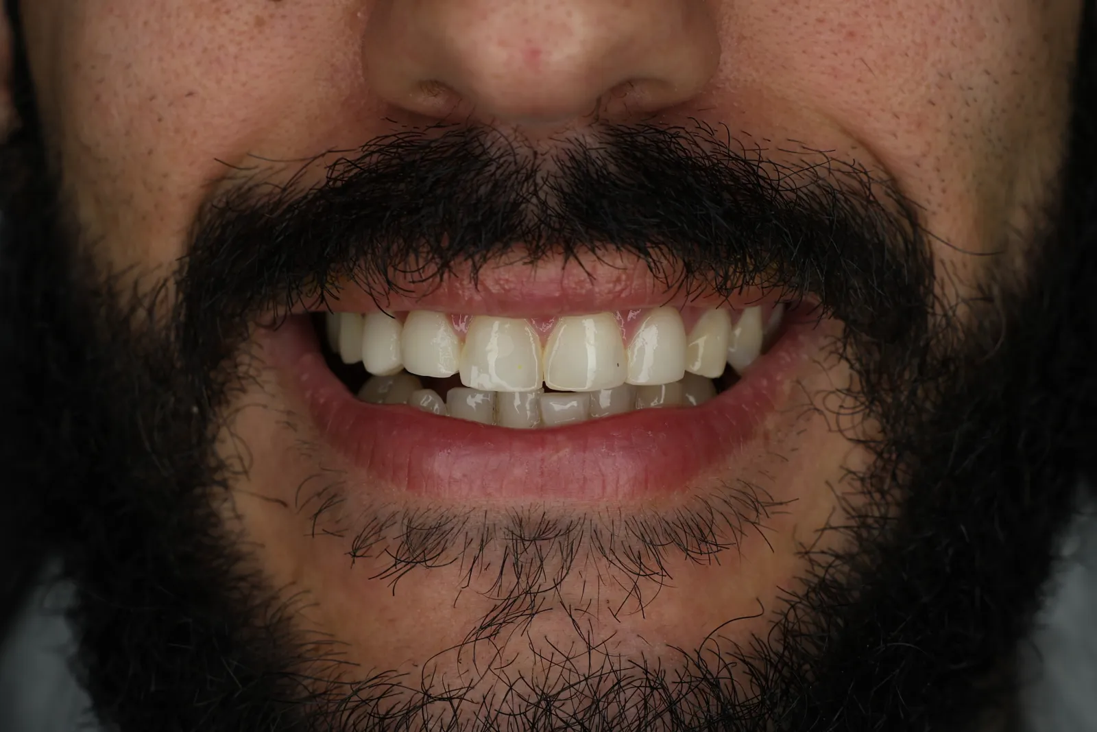 Sorriso prima delle faccette: incisivo scheggiato e denti anteriori irregolari