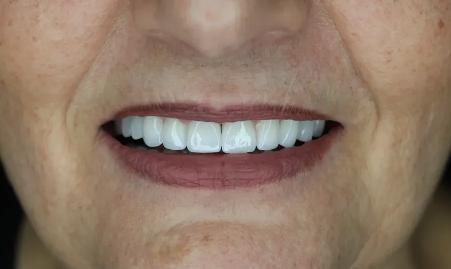 Denti dopo la riabilitazione: impianti e corone fisse su entrambe le arcate
