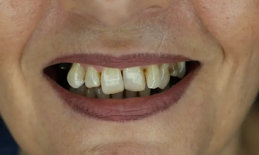 Denti prima del trattamento: elementi mancanti e denti residui usurati e scuriti