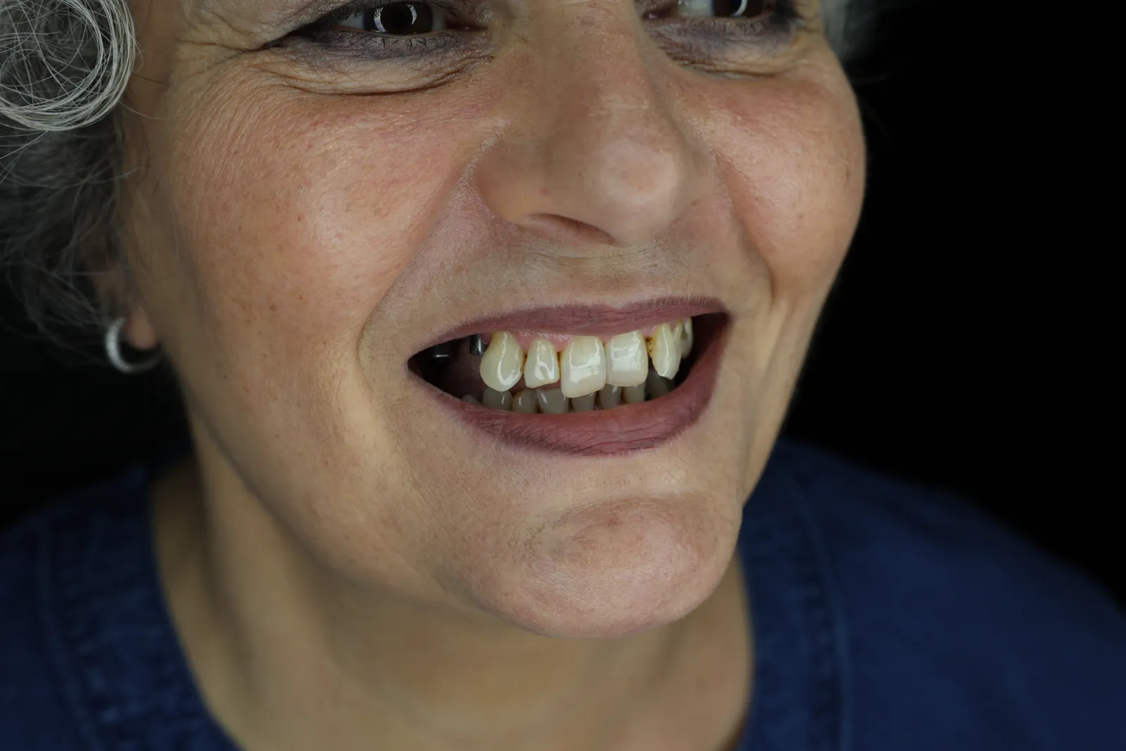 Bocca prima del trattamento: elementi mancanti e denti residui compromessi