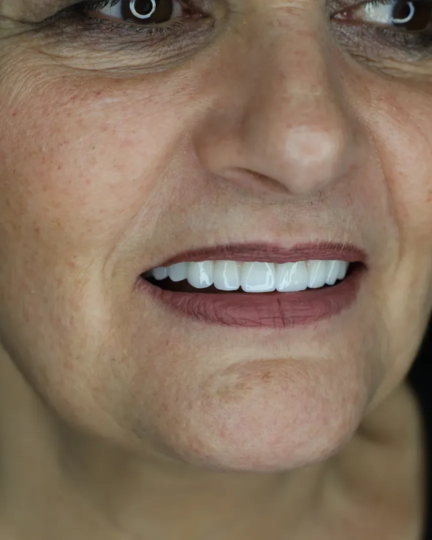 Sorriso dopo la riabilitazione con impianti dentali e corone nella clinica di Tirana