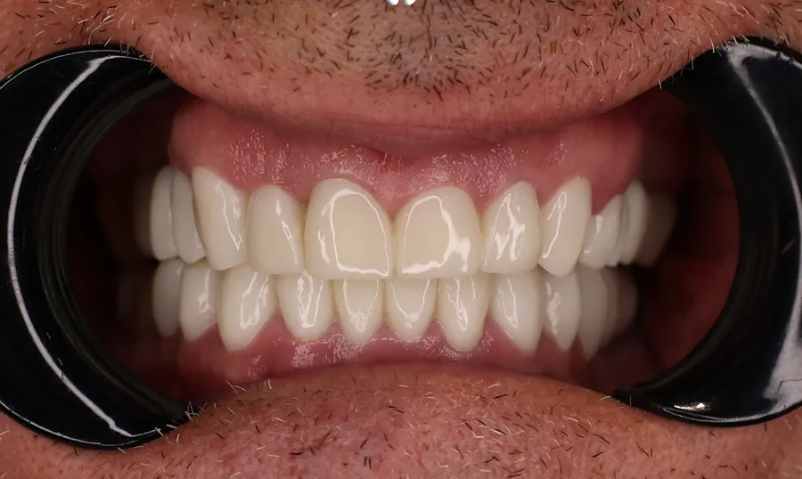 Denti dello stesso paziente dopo il trattamento: corone in ceramica definitive