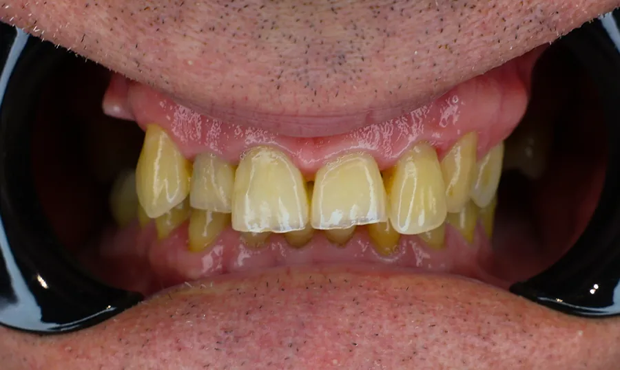 Denti del paziente prima del trattamento: ingialliti e irregolari