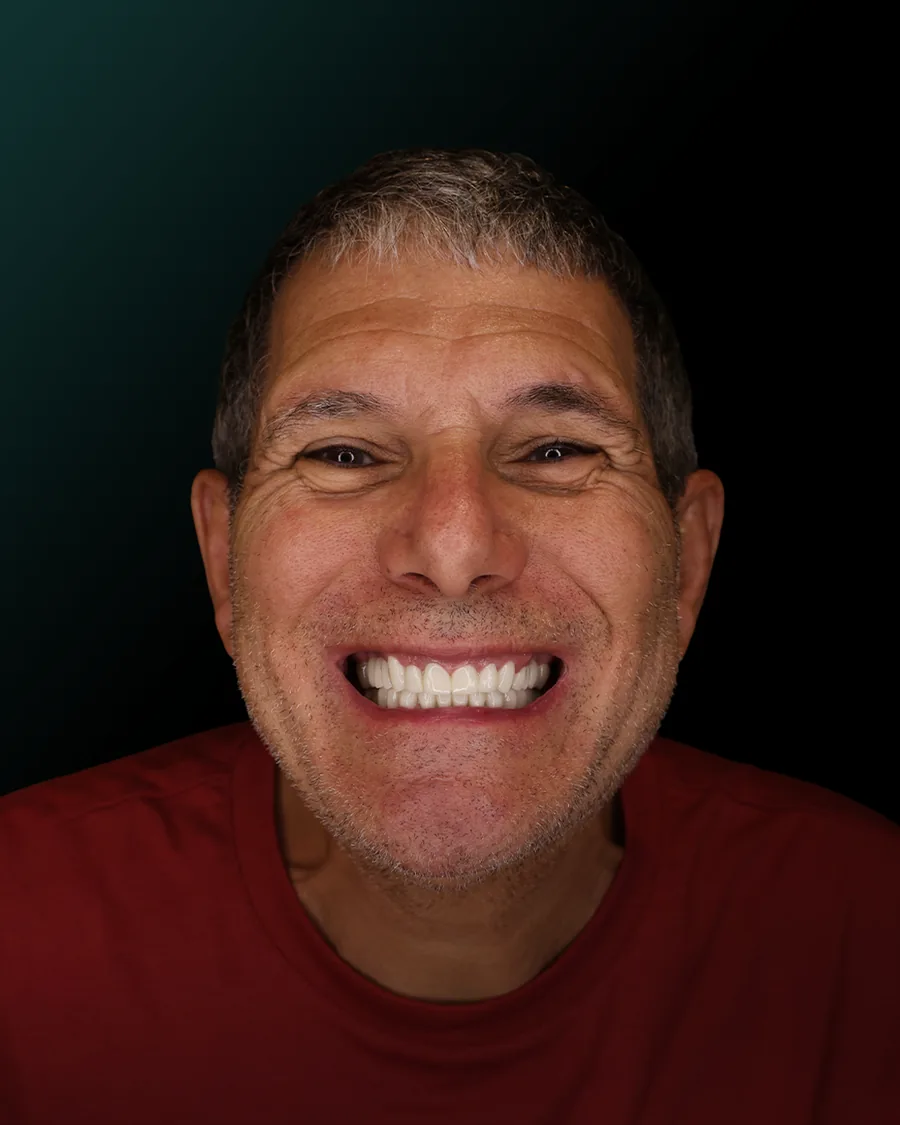 Paziente italiano sorride dopo il trattamento con corone in ceramica nella clinica DentalCare One di Tirana