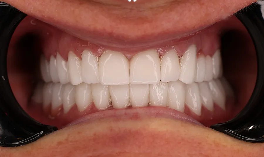 Denti della stessa paziente dopo il trattamento: nuove corone in ceramica