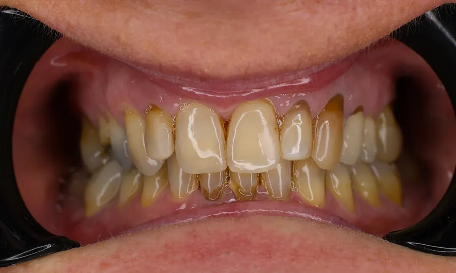 Denti della paziente prima del trattamento: vecchie corone scurite e margini anneriti