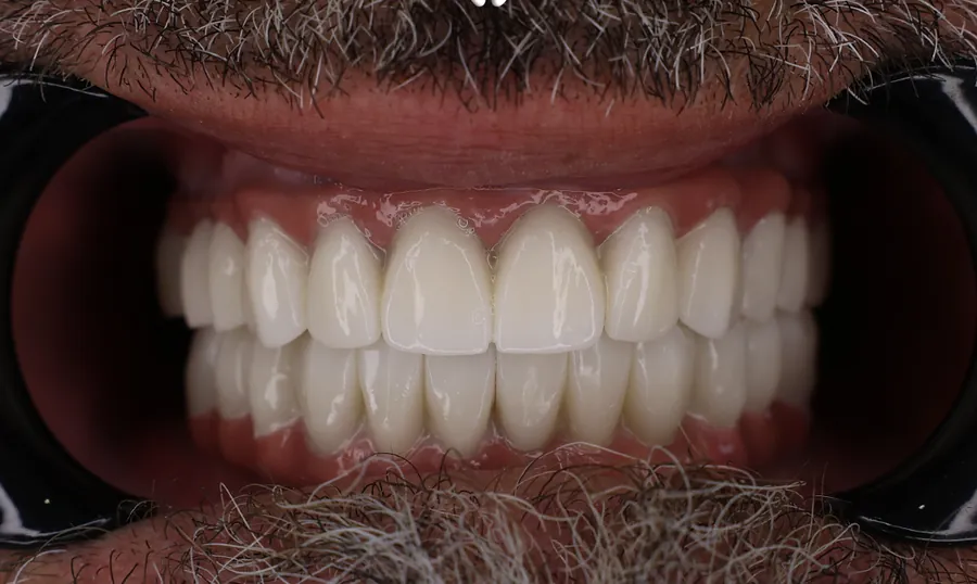 Denti dello stesso paziente dopo la riabilitazione completa in ceramica