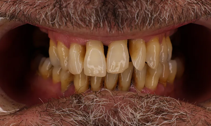 Denti del paziente prima del trattamento: distanziati e ingialliti