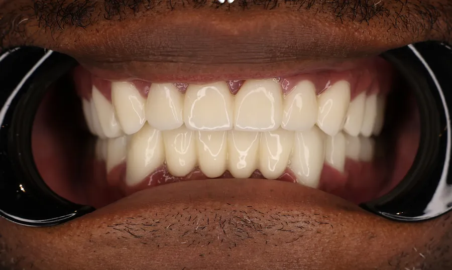 Denti dello stesso paziente dopo il trattamento: corone in ceramica definitive
