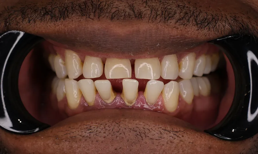 Denti del paziente prima del trattamento: recessioni gengivali e spazi tra i denti