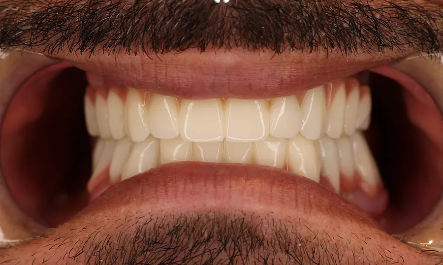 Denti dello stesso paziente dopo la riabilitazione protesica completa
