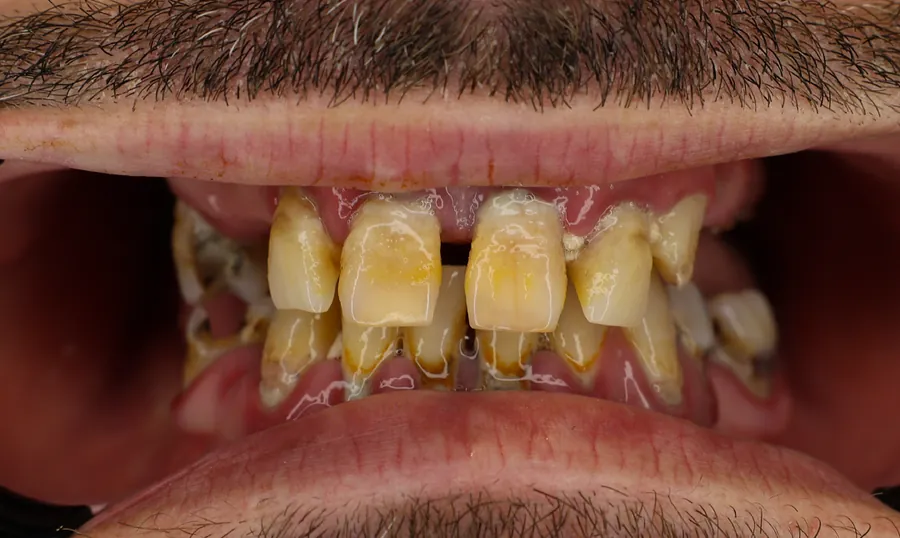 Denti del paziente prima del trattamento: gravemente compromessi dalla carie