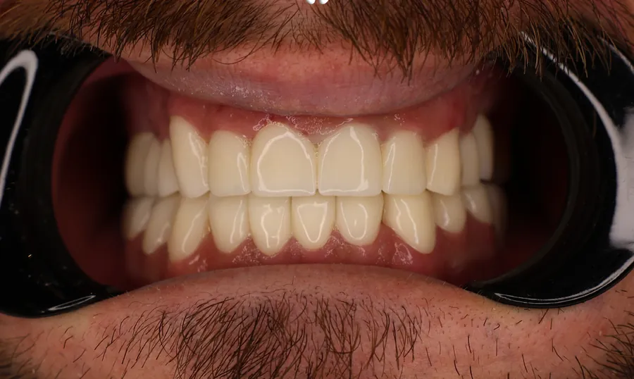 Denti dello stesso paziente dopo il trattamento: corone in ceramica