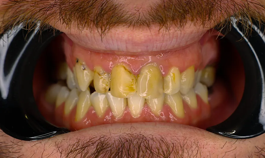 Denti del paziente prima del trattamento: incisivi scheggiati e compromessi