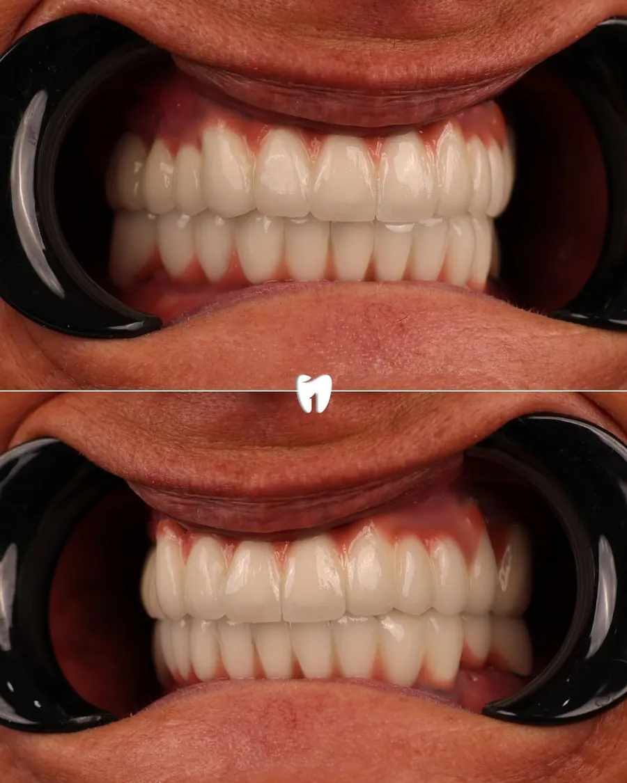 Dettaglio con divaricatore delle 24 corone in zirconia sulle arcate superiore e inferiore