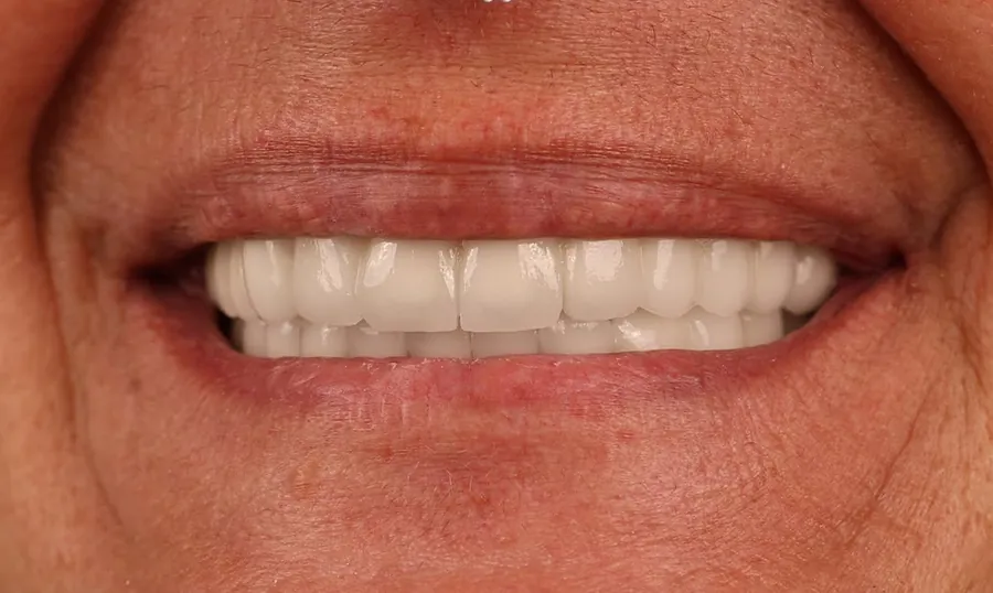 Gli stessi denti a riposo dopo il trattamento