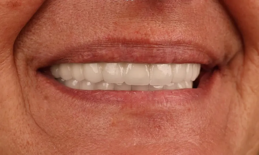 I denti dopo il trattamento, vista laterale