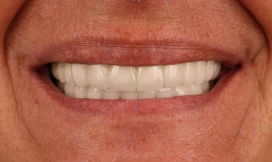 I denti dopo il trattamento: 24 corone in zirconia sulle due arcate