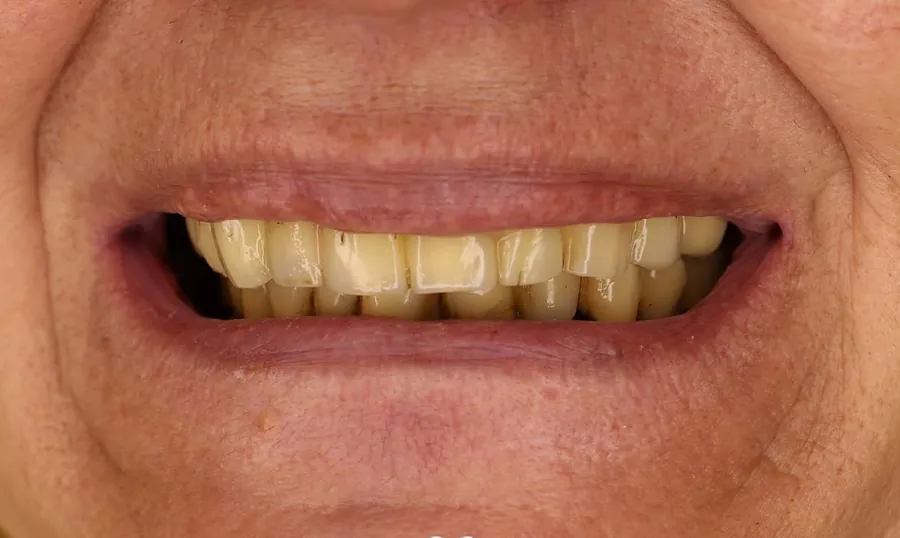 Gli stessi denti a riposo prima del trattamento