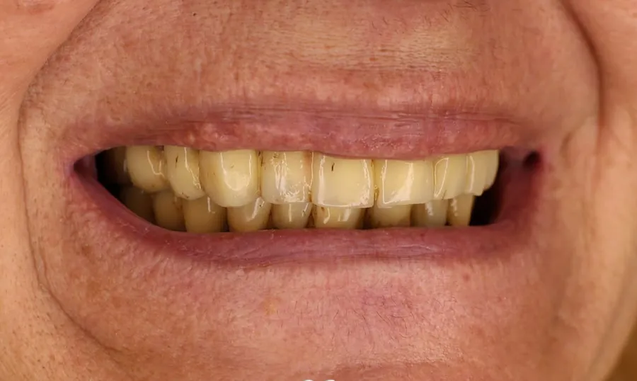I denti prima del trattamento, vista laterale