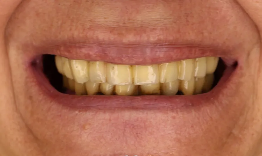 I denti prima del trattamento: consumati, ingialliti e con margini scuri