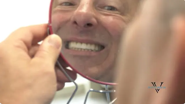 Lello mostra il nuovo sorriso nel servizio di Quinto Potere